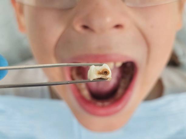 Best Emergency Dentist for Special Needs Patients in Roanoke, IN